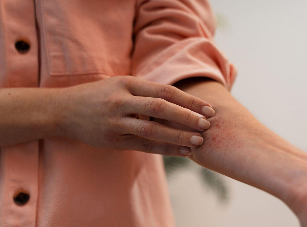 Día Mundial de la Dermatitis Atópica: JOHNSON'S® y DIM Centros de Salud destacan la importancia del cuidado temprano.